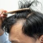 Solusi tanam rambut di Indonesia