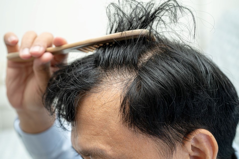 Solusi tanam rambut di Indonesia