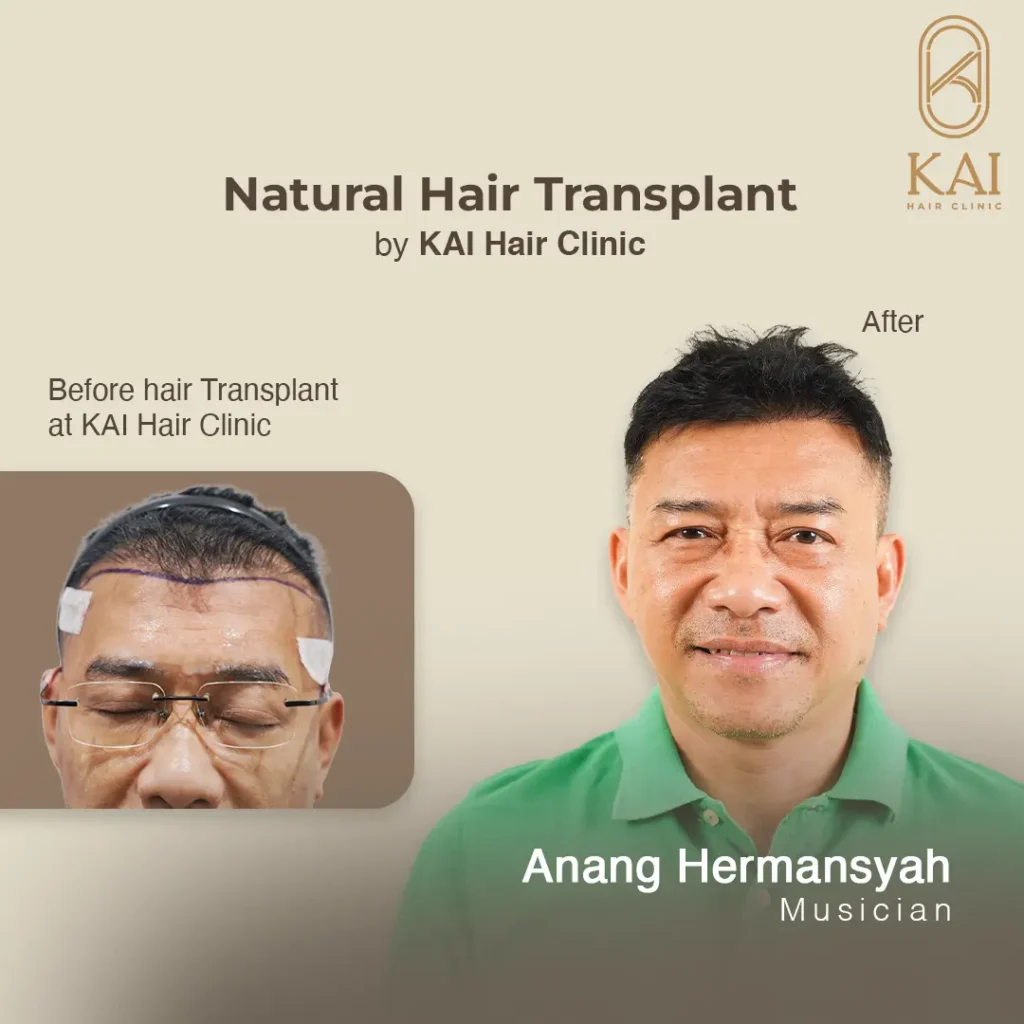 hasil transformasi before after tanam rambut di Jakarata