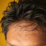 Pantangan Setelah Tanam Rambut di Jakarta: Apa yang Boleh dan Tidak Boleh?