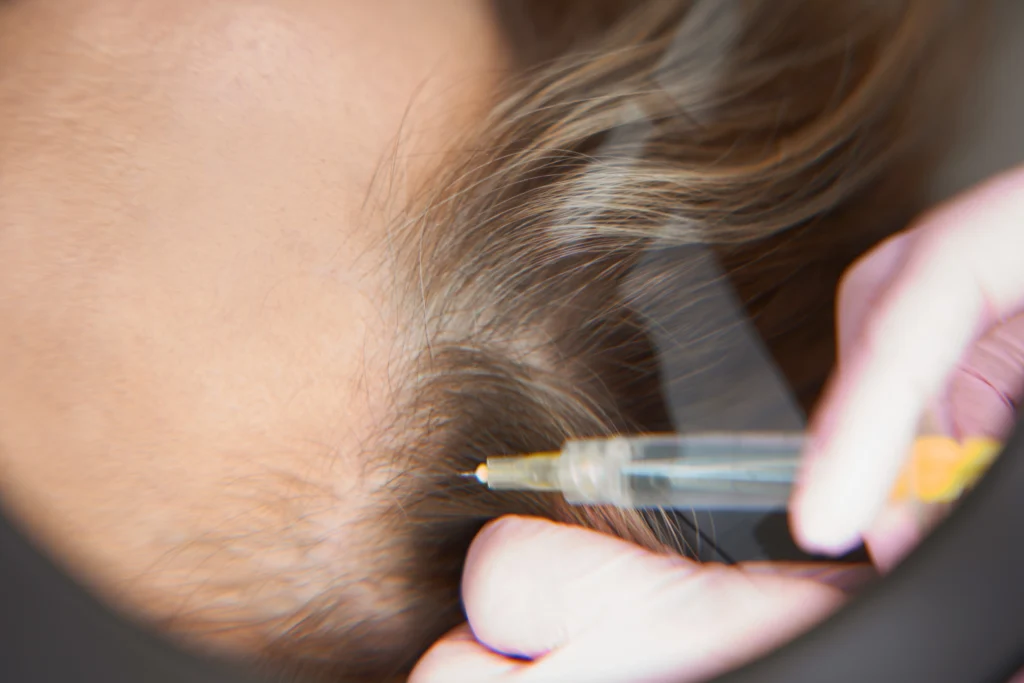 Gak Cuma Pria, Wanita Juga Banyak yang Hair Transplant Lho! Buat Apa Sih?