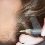 Gak Cuma Pria, Wanita Juga Banyak yang Hair Transplant Lho! Buat Apa Sih?