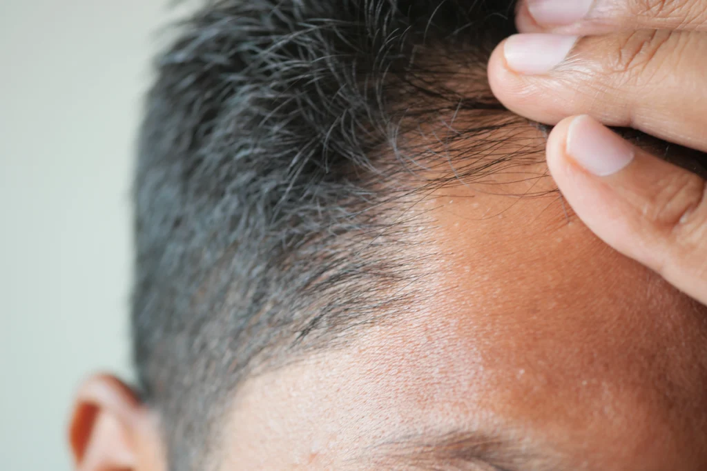 Kenapa Hairline Jadi Penentu Hasil Hair Transplant yang Natural?