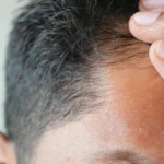 Kenapa Hairline Jadi Penentu Hasil Hair Transplant yang Natural?