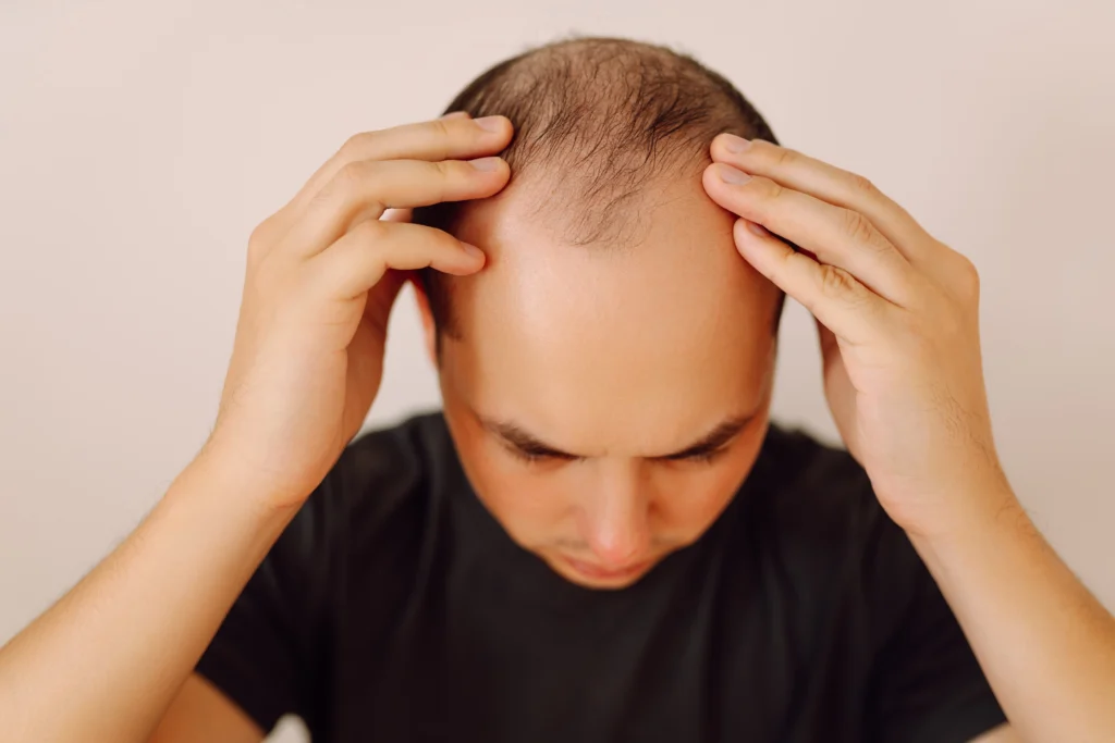 Rambut Tipis karena Genetik? Kapan Waktu Tepat Hair Transplant?