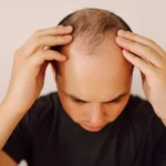 Rambut Tipis karena Genetik? Kapan Waktu Tepat Hair Transplant?