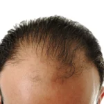 Tanam Rambut di Jakarta Kini Lebih Natural | Rahasianya Ada Dini!