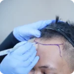 Fokus Hairline Atau Area Crown Saat Hair Transplant di Jakarta?