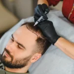 Bisa Nggak Hair Transplant Jakarta untuk Jidat Lebar? Ini Faktanya