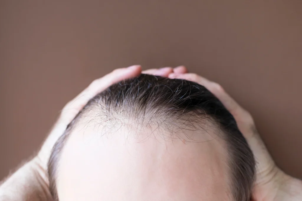 Hair Transplant Jakarta Fokus ke Natural, Bukan Sekadar Tebal?