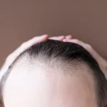 Hair Transplant Jakarta Fokus ke Natural, Bukan Sekadar Tebal?
