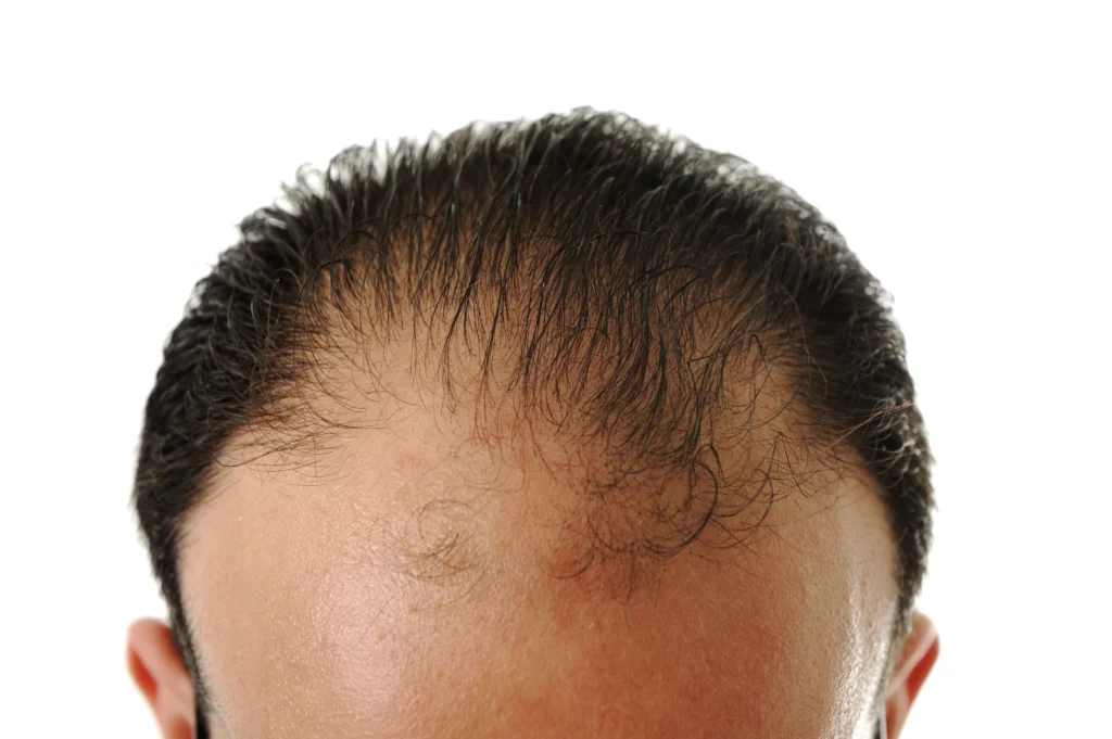 Rambut Rontok, Kapan Harus Pertimbangkan Hair Transplant?