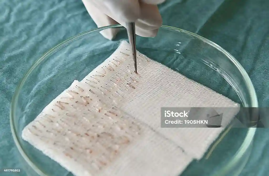 Hair treatment vs hair transplant untuk solusi penipisan dan kebotakan rambut di KAI Hair Clinic